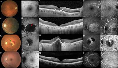 Age-Related Macular Degeneration Revisited: From Pathology and Cellular Stress to Potential Therapies